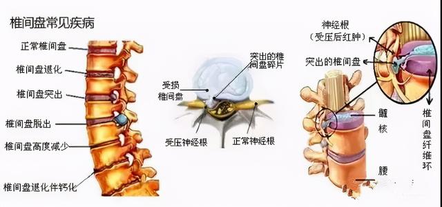 腰椎间盘突出