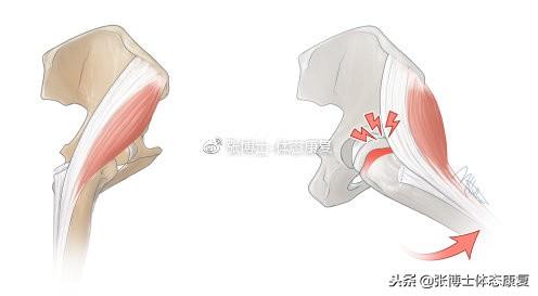 疼痛|「译文分享」弹响髋综合征的成因分析与康复方法