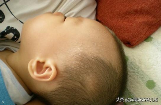 超级宝妈|枕秃、盗汗、不长个儿，宝宝缺钙？儿科医生：补错钙，危害更大