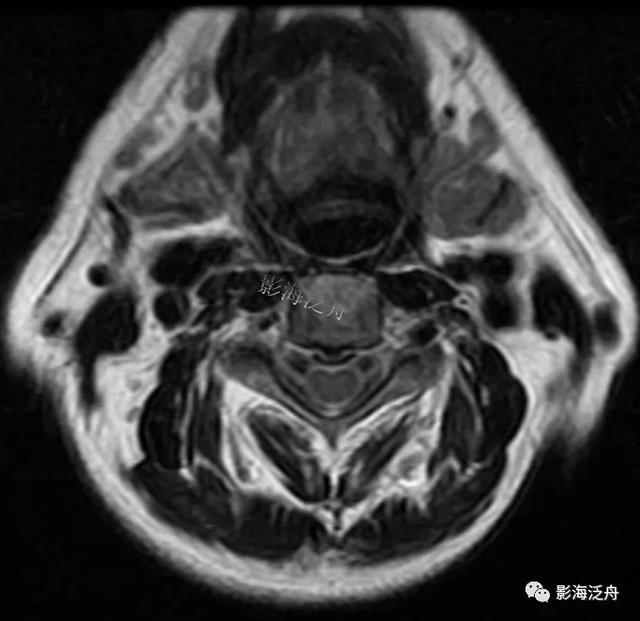 典型病例——颈椎后纵韧带钙化（MR）