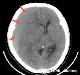 硬膜外与硬膜下出血的血来自哪里