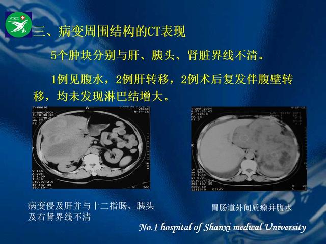 李健丁教授：胃肠道外间质瘤的CT表现和临床病理分析