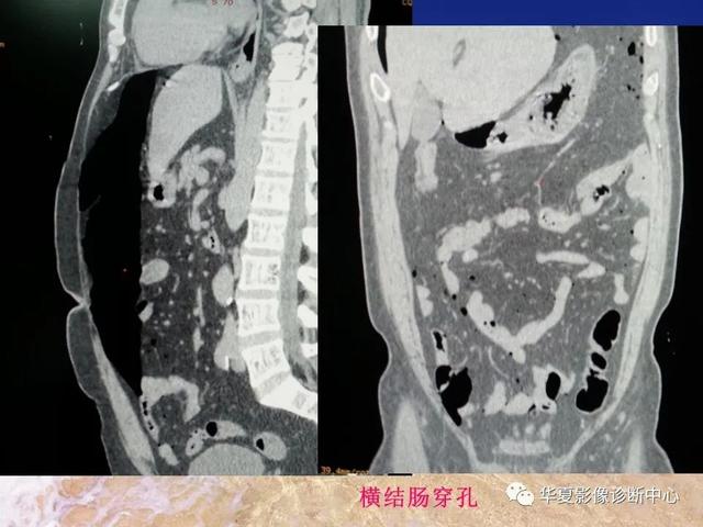 消化道穿孔的CT诊断