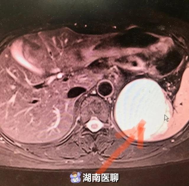 「你的育儿经」46岁女子在备孕期发现巨大肿瘤！专家提醒：孕前这些外因不可忽视