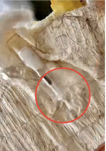 「暖先生格调」留置针管断裂在婴儿体内，一年多未找到！这种悲剧该如何避免？
