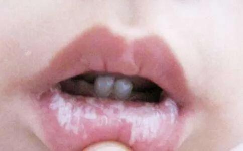 逗比大家庭|疱疹性咽峡炎又到高发期！别与手足口病、口腔溃疡搞混了