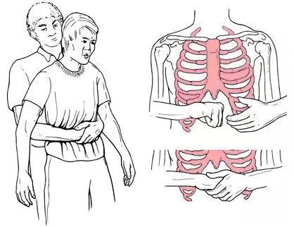 重点知识：学会海姆立克急救法