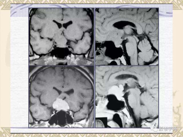 垂体病变的MRI诊断