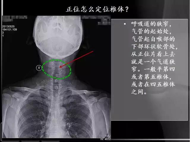 通俗易懂的脊椎X光片读片指南，值得收藏