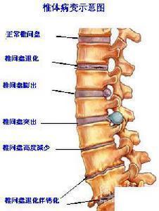 椎间盘|腰椎疾病、腰椎间盘突出你想知道的事全集！