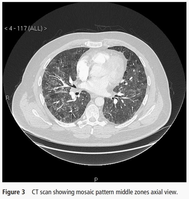 呼吸困难多次被误诊，只因一床被子？