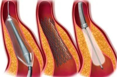 心肌梗死后，植入支架，还能活多久？心血管医生告诉你