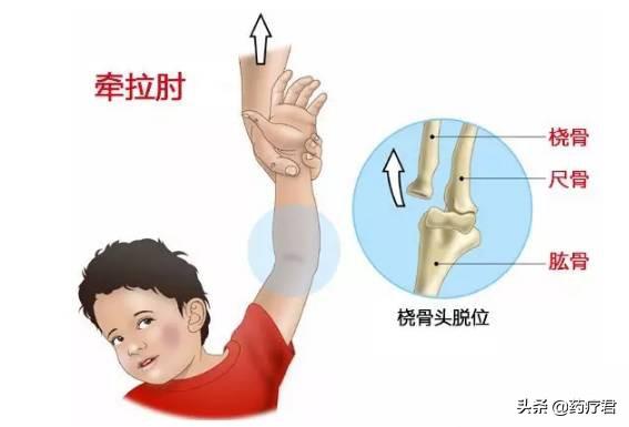 你的育儿经|只是拉了下宝宝,胳膊就动不了了,这事很多家长都遇到过
