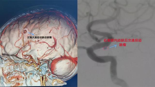 介入|和济医院成功为患者拆除2枚颅内“炸弹”