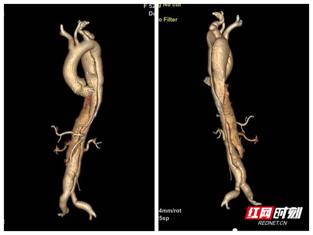 19小时手术完成胸部“拆弹”常德一医实施湘西北首例全胸腹主动脉置换