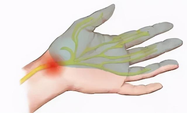 手麻、手疼、手无力，这下终于知道为什么了