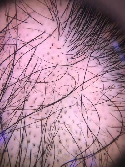 冲动性|“10后”也秃了？台州两个小学生不断脱发，查了半天，真相是这个