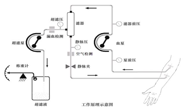 聚焦 ?宽仁前沿｜第18期 顽固性心衰利尿难？他们给心脏装了个“水泵”