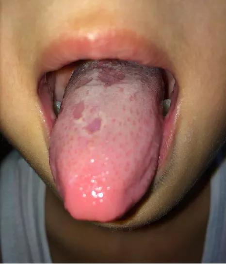 #你的育儿经#孩子下眼睑红，出现地图舌后常生病，应该如何调理？