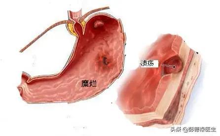 腹痛腹胀不消化，幽门螺旋杆菌感染为什么要根治？如何选择药物？