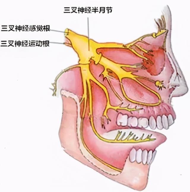 浅谈三叉神经痛的基本认识