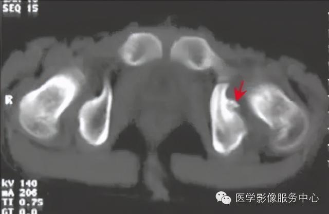 收藏 |：79种典型骨肌影像病例，助你诊断无忧