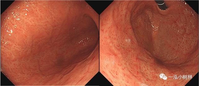 5张图，带你看懂「京都胃炎分类」！| 内镜集锦