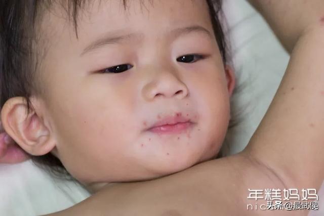 烟雨琴殇|5岁女孩40℃高烧、便血！夏天这几种水果，别乱给娃吃！