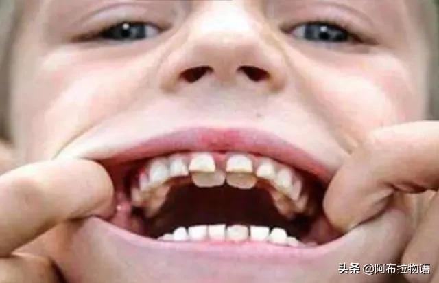「超级宝妈」父母别扔掉孩子的乳牙，关键时刻能救孩子一命，是真的吗？
