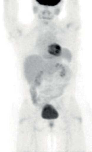 打破传统治疗标准！拉罗替尼挑战转移性非小细胞肺癌的一线治疗