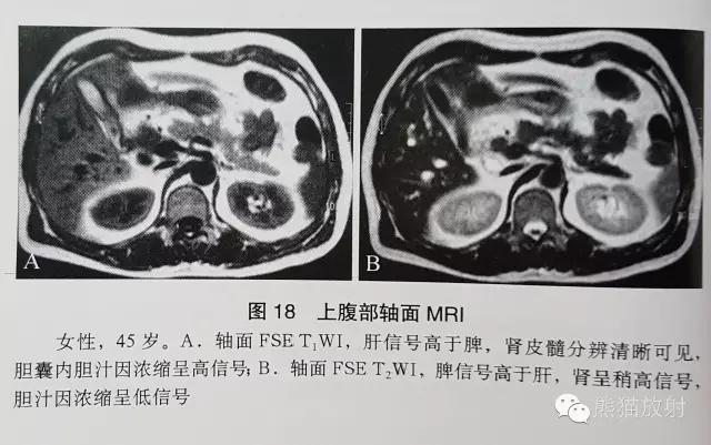 「MRI入门」如何分辨T1WI与T2WI？