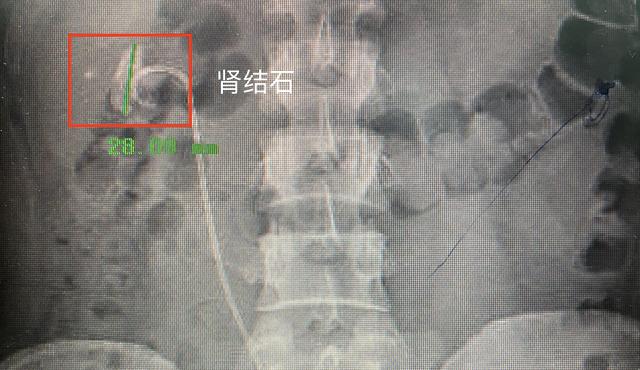 小便带血，医生我该怎么办？别紧张，泌尿外科医生告诉你