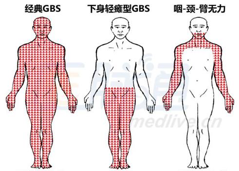 辉瑞COVID-19疫苗组惊现4例面瘫，是不良反应？