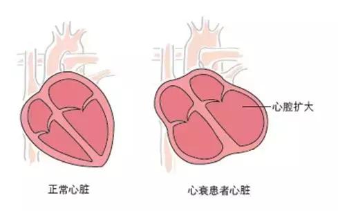 糖尿病|「专病专讲」心衰专题之哪些疾病可以引起心衰？