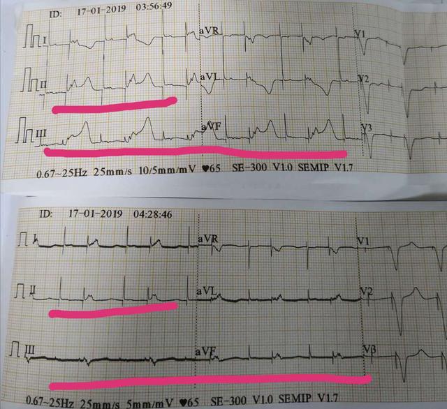 心电图|63岁阿姨半夜胸痛，诊断心梗，心脏造影血管完全正常！什么原因？