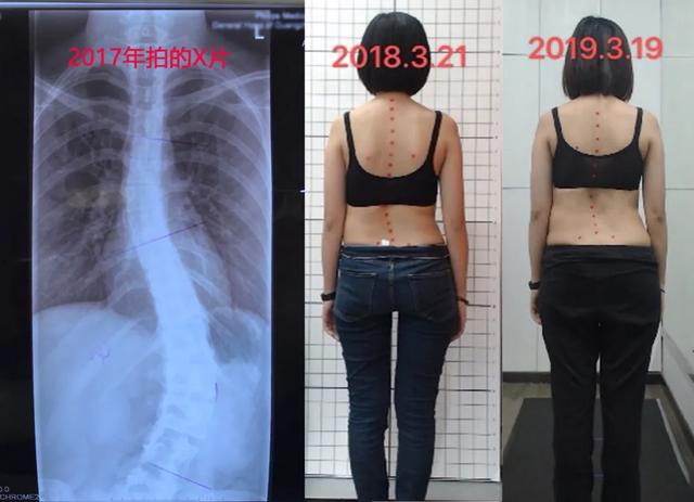 你的育儿经■脊柱侧弯十多年，2年康复训练后，我成为幸孕妈妈