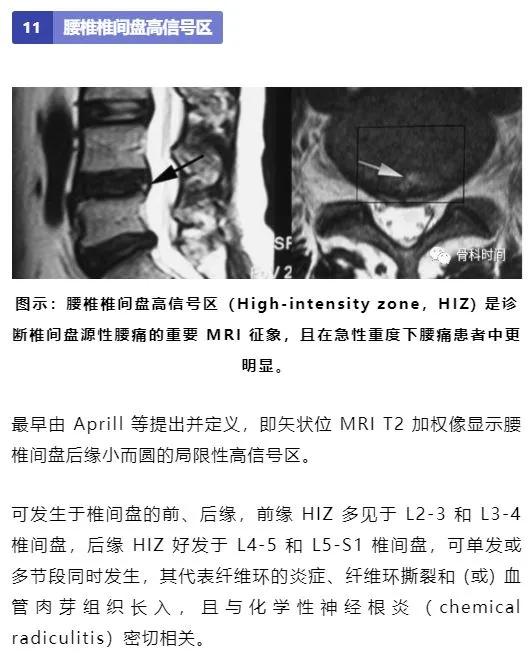 影像经验！脊柱的 13 个影像学特征