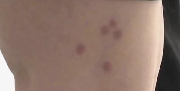 小琳|清明出游后腿上多了几个红斑！医生紧急提醒