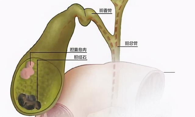 你觉得胆结石没什么？错了，胆结石会引起癌中之王：胆囊癌