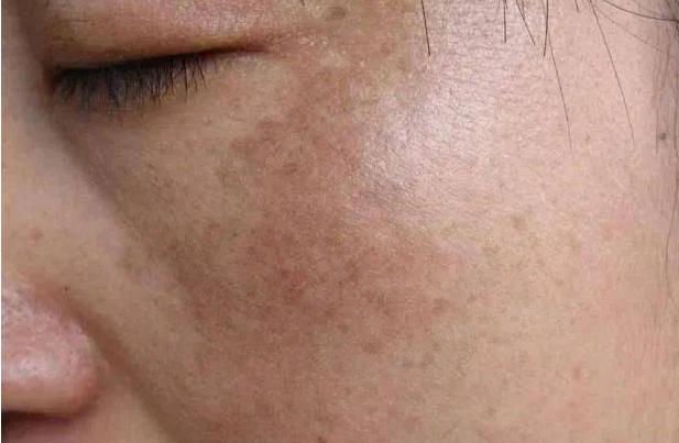 一家四口儿|怀孕长了黄褐斑？这些常见妊娠皮肤病，危及宝宝健康