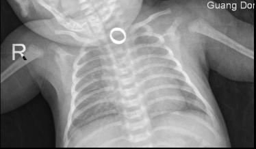 儿童|惊魂！宝宝满月当天手戴五只金戒指，玩着玩着突然出现可怕一幕……