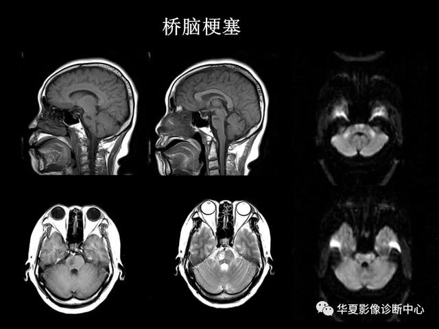 「影像复习」脑干区常见病变影像表现