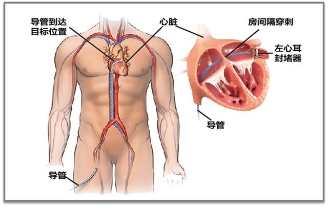 宝山首例ICE指导下房颤“一站式”介入治疗在仁济医院宝山分院成功开展