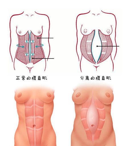 南浔的梦|孕前小蛮腰，产后变肉包，那是因为你的腹直肌分离了