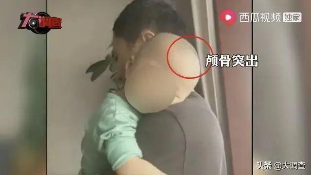 #中国青年网#湿疹、酷似“大头娃娃”……多名幼儿食用同款“奶粉”后患同一种病,当地成立调查组