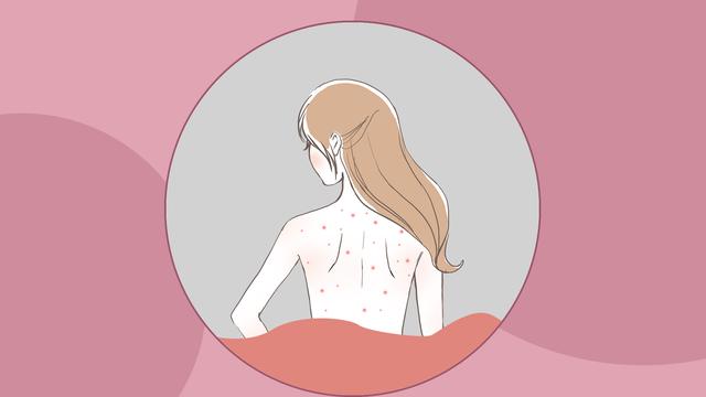 「你的育儿经」孩子青春期长痘痘，家长不要不在意，这些小技巧帮助您