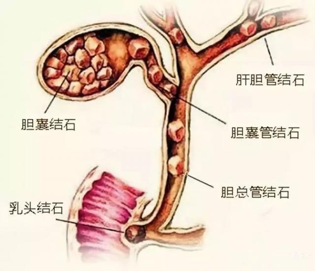 胆结石患者听过最绝望的一句话：结石不够大，等养大了再来治