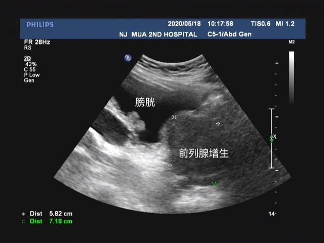 1分钟泌尿外科医生带你简单了解什么是泌尿系彩超