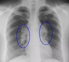 息肉|体检查出结节、息肉、囊肿、增生……哪个才是癌症的先兆？