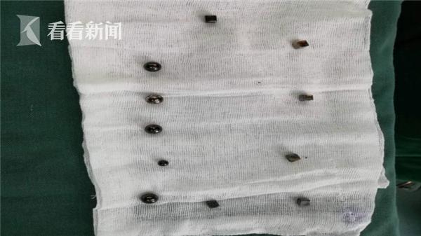 你的育儿经|2岁半女童误吞14粒“磁力珠”肠子破了7个洞